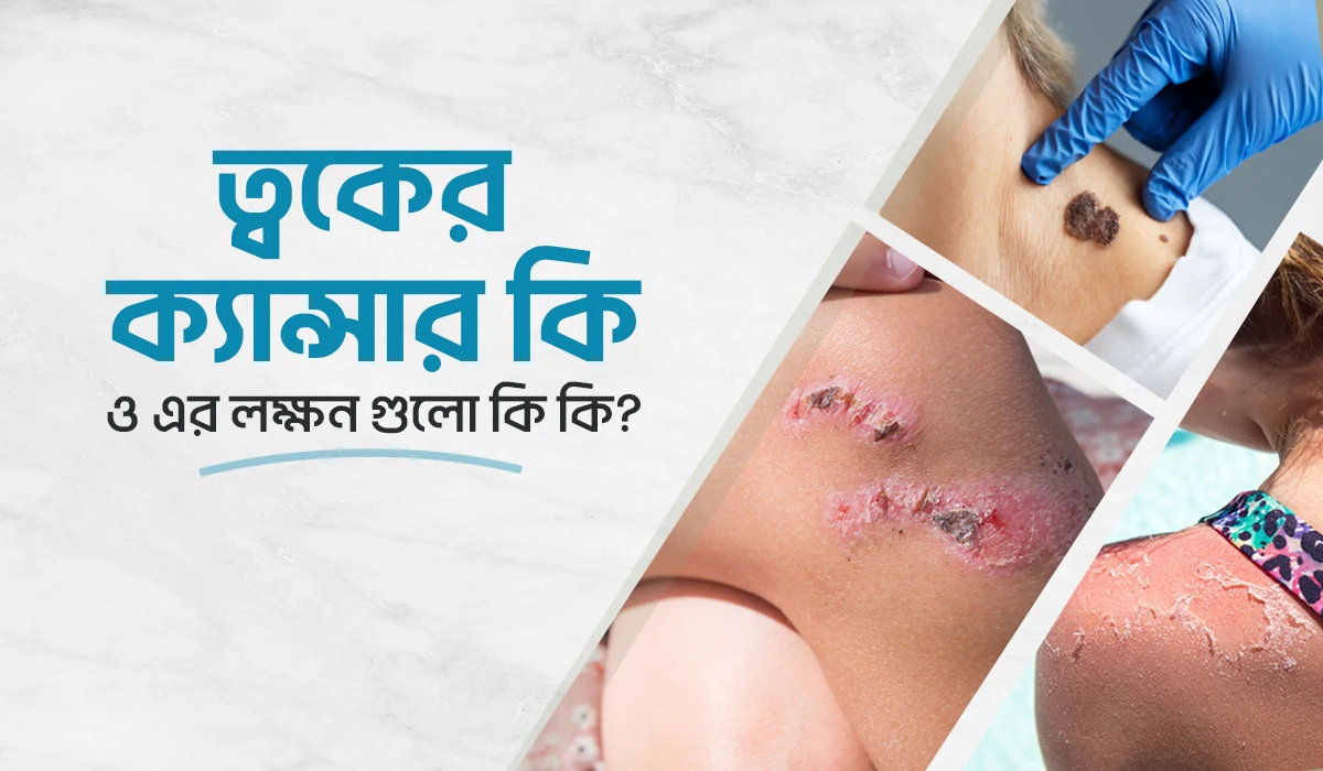 ত্বকের ক্যান্সার কি ও এর লক্ষণ গুলো কি কি?